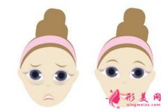 抽脂法去眼袋有什么優(yōu)勢(shì)？