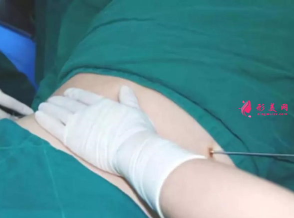 吸脂瘦腹部多少錢