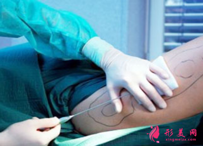腿部吸脂后多久可以走動(dòng)