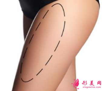 腿部吸脂后多久可以走動(dòng)