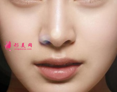 隆鼻后鼻子經(jīng)常發(fā)紅是怎么回事