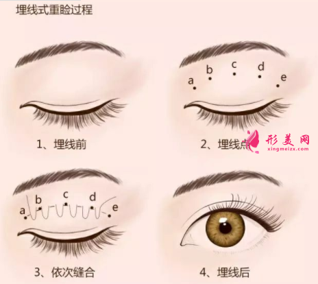 廣州埋線雙眼皮要多少錢