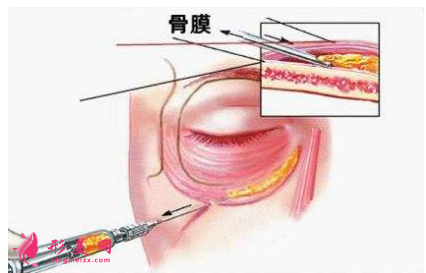 淚溝填充價格