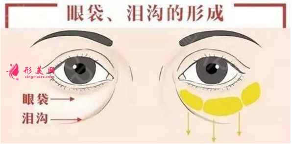 淚溝填充價格