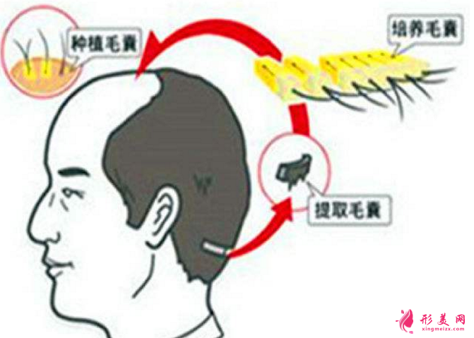 種植頭發(fā)需要多少錢