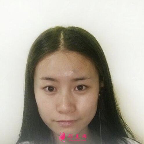 深圳非凡整形醫(yī)院開眼角加雙眼皮體驗
