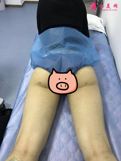 深圳鵬愛整形醫(yī)院大腿吸脂術(shù)案例