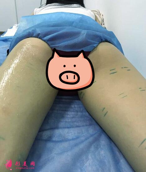 深圳鵬愛整形醫(yī)院大腿吸脂術(shù)案例