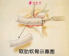 當(dāng)代醫(yī)學(xué)美容醫(yī)院自體肋軟骨隆鼻怎么樣？有什么后遺癥嗎