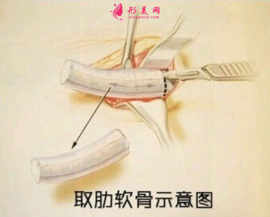 自體肋軟骨隆鼻的后遺癥是什么