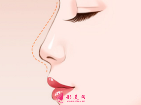 假體隆鼻手術(shù)要多少錢