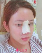 上海九院整形隆鼻怎么樣？鼻子做假體已經(jīng)5個(gè)月了，姐妹們幫我看
