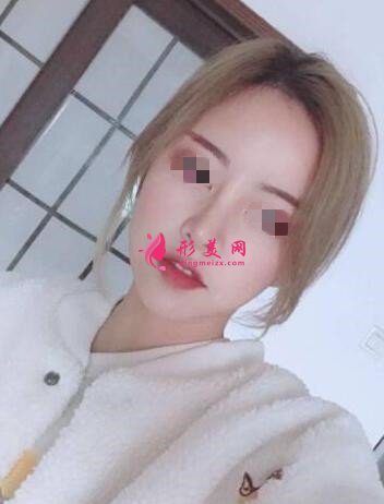 鼻子做假體已經(jīng)5個(gè)月了