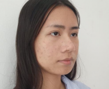 北京同仁醫(yī)院做瘦臉針，輕松擁有小V臉