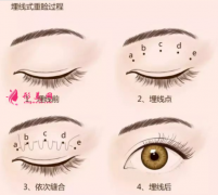 埋線雙眼皮后會脫線嗎？