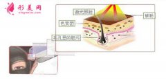 上海華美整型美容醫(yī)院做黑臉娃娃費(fèi)用是多少？會(huì)傷害皮膚嗎？？