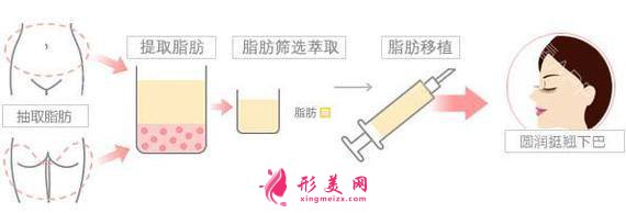 自體脂肪填充面頰價(jià)格