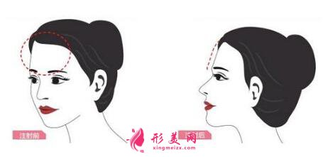 自體脂肪填充面頰價(jià)格