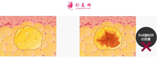 自體脂肪填充面頰價(jià)格