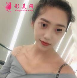 隆鼻經(jīng)驗(yàn)分享貼