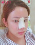 上海九院假體隆鼻5個(gè)月，姐妹們幫我看看成功不！