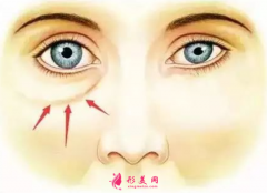 手術(shù)祛眼袋恢復(fù)期要多久？