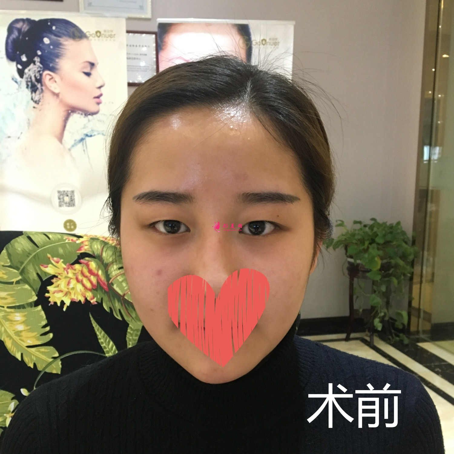 北京雙眼皮修復(fù):魏志香醫(yī)生