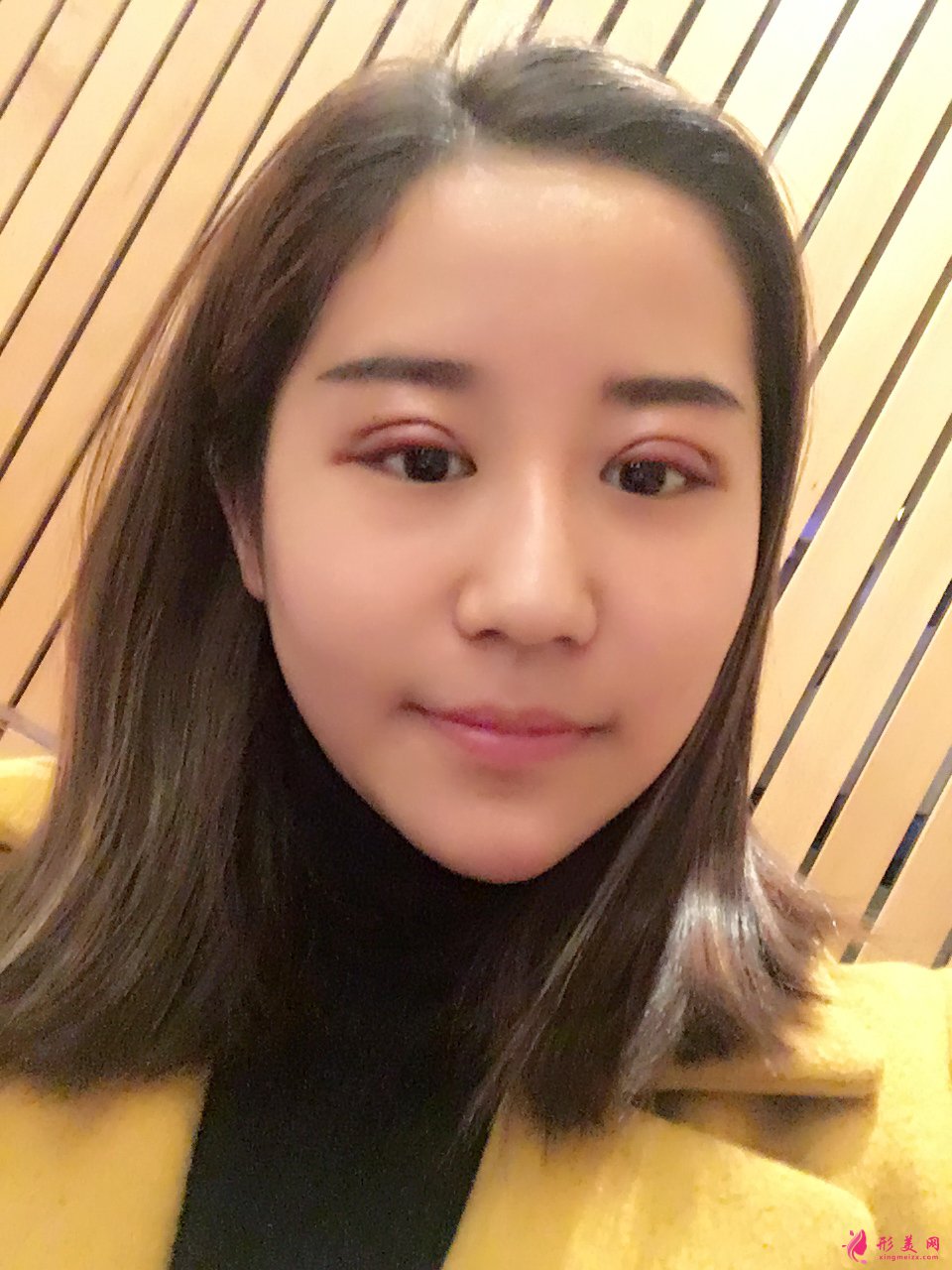 北京雙眼皮修復(fù):魏志香醫(yī)生