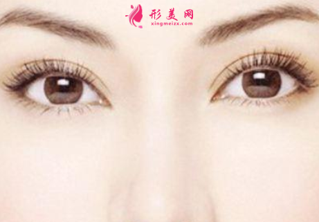 雙眼皮 (2).png