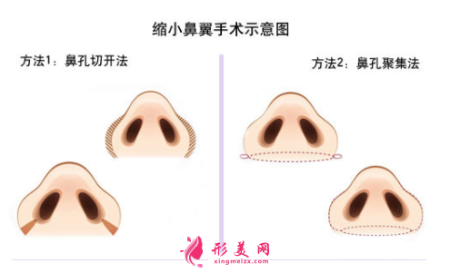鼻翼縮小過(guò)程示意圖.png