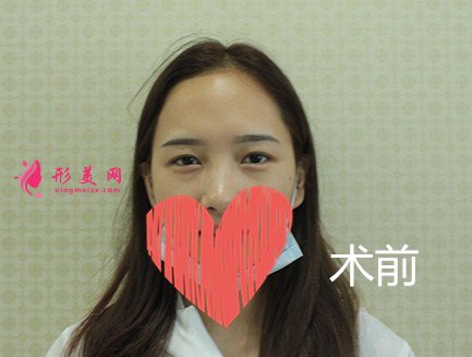 深圳赫思醫(yī)療美容怎么樣？價目表及網(wǎng)紅鼻整形案例