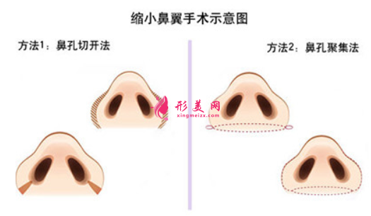 縮小鼻翼手術(shù)示意圖.png
