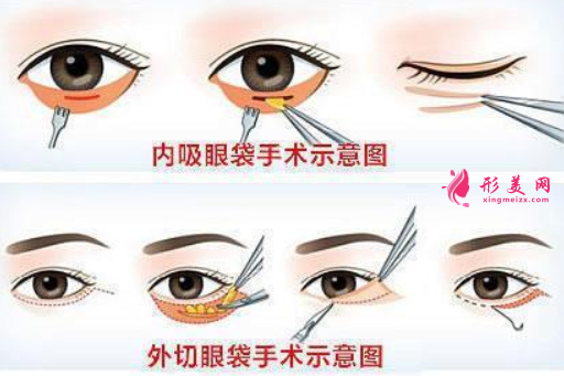 怎么降低手術(shù)祛眼袋的風(fēng)險(xiǎn).png