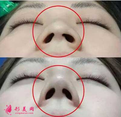 鼻頭縮小真人案例分享