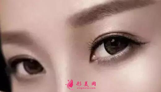 韓式三點式好嗎？簡單概括一下韓式三點雙眼皮的優(yōu)勢！
