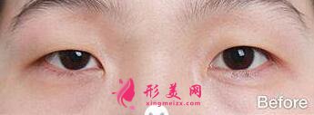 韓式三點式雙眼皮適合的人群