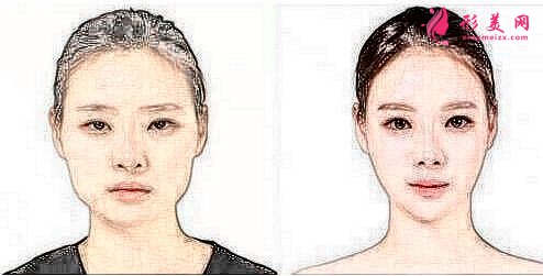 面頰部吸脂方法