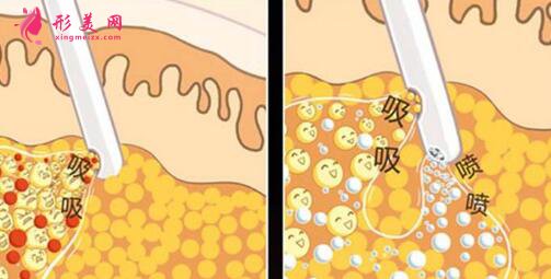 何時(shí)能見到抽脂最好的效果?