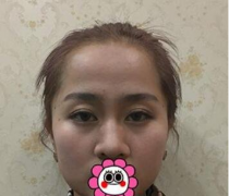 上海首爾麗格做鼻綜合怎么樣？附2020整形美容價(jià)格表+案例展示