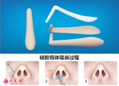 假體隆鼻效果可以保持多久？