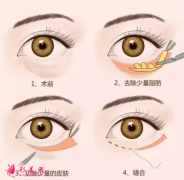 手術(shù)祛眼袋的誤區(qū)你清楚嗎？