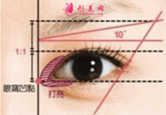 開眼角后會有回縮嗎？