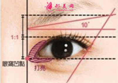 開眼角后會有回縮嗎
