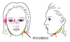 南寧下頜角切除真的可以讓臉變小嗎？