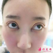 廣州壹加壹整形醫(yī)院做雙眼皮怎么樣?真人案例+價(jià)格表