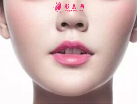 鼻翼縮小手術(shù)一般要多少錢