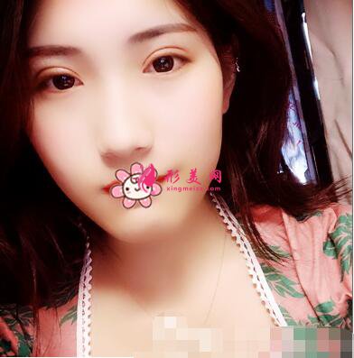 深圳何瑋醫(yī)生雙眼皮術(shù)后15天效果圖