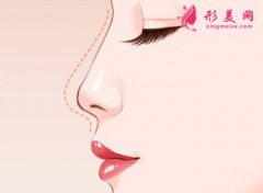 南京假體隆鼻的價(jià)格是多少？