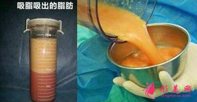脂肪隆下巴手術(shù)的優(yōu)點