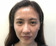 廣州藝美張濤自體脂肪填充全臉怎么樣？真人案例分享